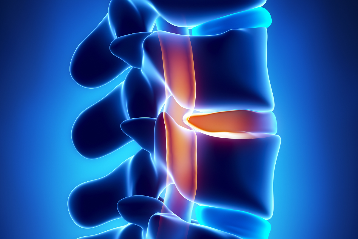 Tiziana Life Sciences Shows Breakthrough in Spinal Cord Injury Treatment
